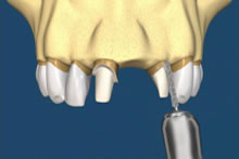 Cei doi dinți adiacenți sunt ajustați