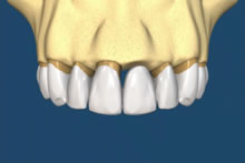 Puntea se fixează peste dinți și înlocuiește dintele lipsă.