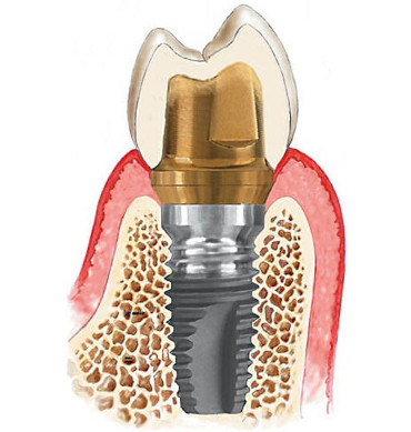 implant-4